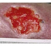 Subject 1 Photo A - Wound Healing