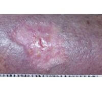 Subject 1 Photo C Wound Healing