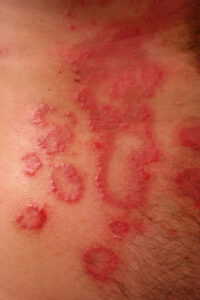 inflammation red rash