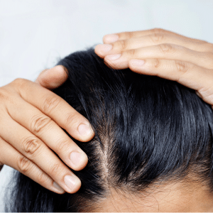 hair loss