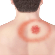 Tick Bite - Bullseye